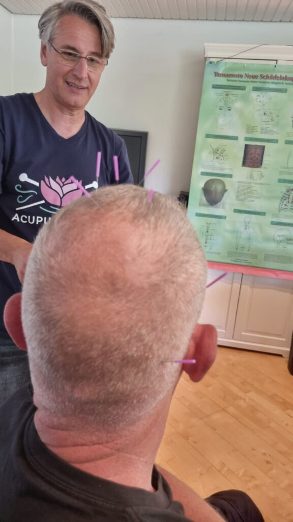 Akupunkteur behandelt Mann mit Nadeln im Kopf.